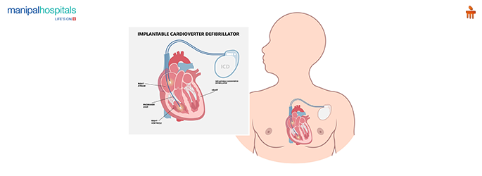 arrhythmia treatment