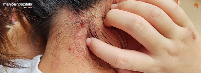 Psoriasis rash signs