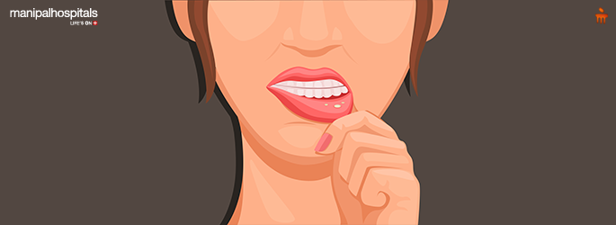 Illustration of a woman with lip irritation due to fungal infection (oral thrush)