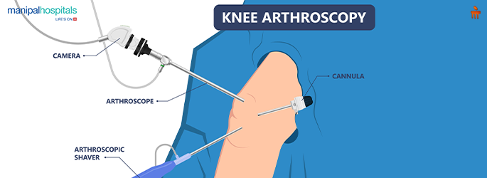Joint Replacement Surgery: What to Expect Before, During & After