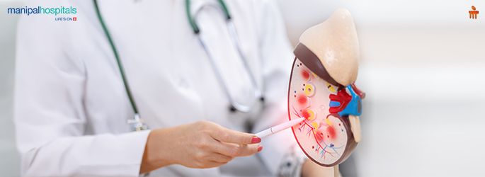 Kidney Stones Explained: Causes, Symptoms and the Most Effective Treatment Options
