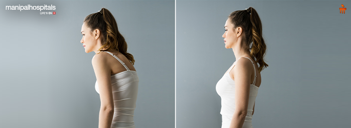 Kyphosis Explained: Causes, Symptoms, and How to Fix It Without Surgery