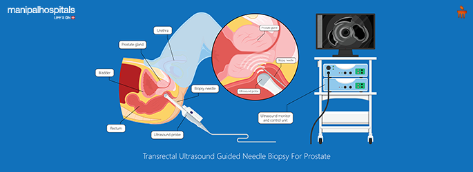 laparoscopic prostatectomy