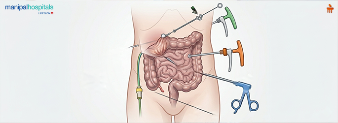 Hemicolectomy surgery
