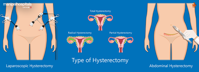 Laparoscopic vs. Open Surgery It's Difference
