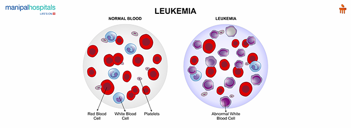 Leukemia Symptoms, Causes and treatments