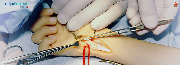 limb salvage surgery