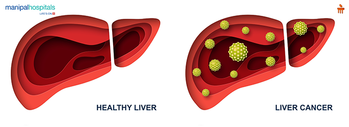 Liver Cancer Treatment