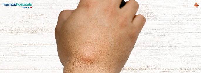 Lump or Swelling in the Body: Causes, Cancer Signs & When to See a Doctor?