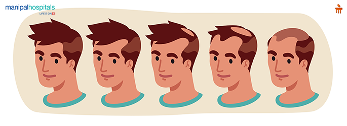 Thinning hair in men