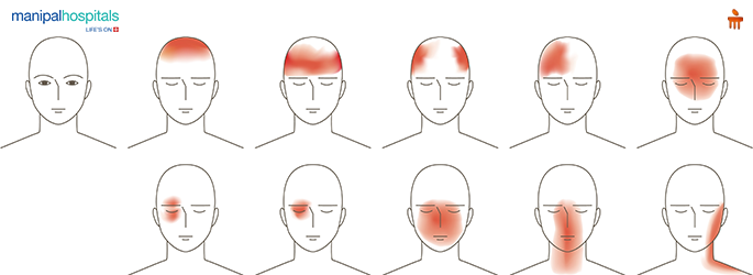Migraine vs Tension Headache