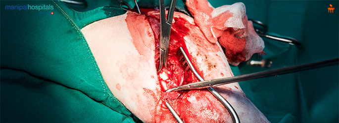 Minimally Invasive Surgery vs Open Surgery in Cancer