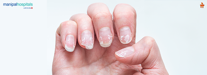 Nail Infection Treatment