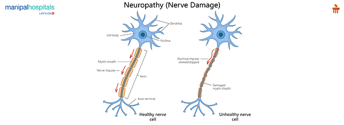 Nerve Damage