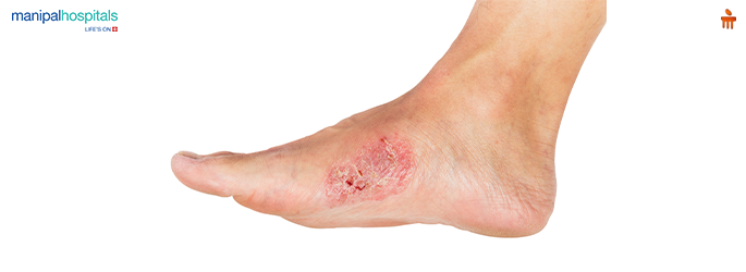 Non-Healing Foot Ulcers Explained: Causes, Risks, and Evidence-Based Treatments