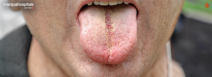 Oral Lichen Planus: Causes, Symptoms & Treatment Options