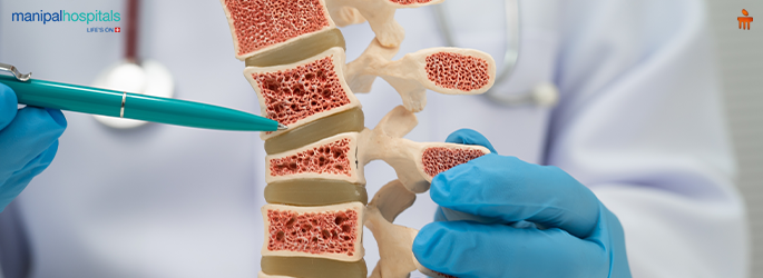 Osteoporosis symptoms causes treatment and prevention