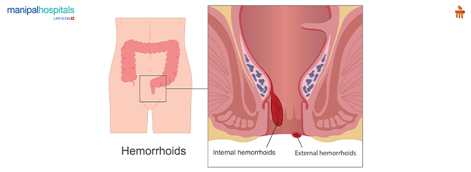 Painless piles surgery for female patients
