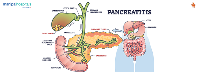 acute pancreatitis: causes, symptoms and treatment