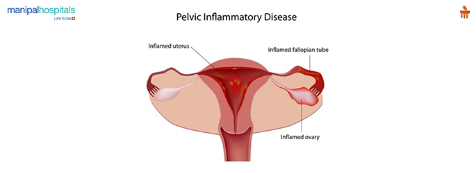 Pelvic inflammatory disease treatments