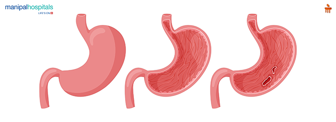stomach ulcer treatment