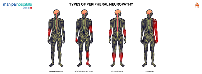 Peripheral Neuropathy Care