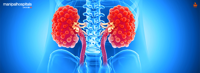 Polycystic Kidney Disease: Early Diagnosis & Advanced Treatment