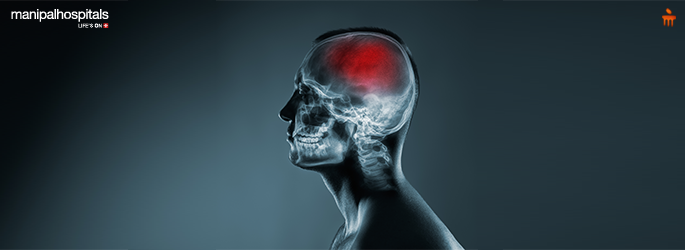 Prevent Ischemic Stroke: Risks & Prevention Tips