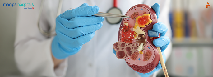 Prevent kidney stones water intake diet lifestyle tips