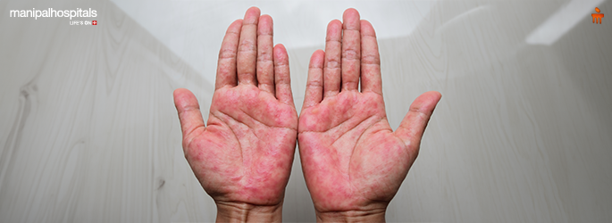 Red Rashes on Skin