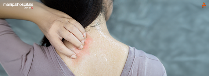 Heat rash relief and prevention