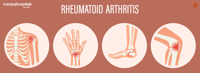 Rheumatoid Arthritis Treatments: Options for Managing Symptoms