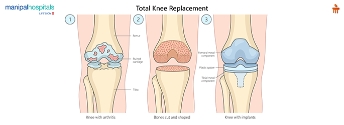 Robotic Knee Replacement Surgery