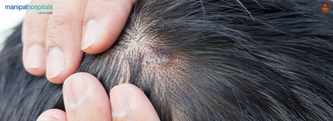 Scalp Acne: Causes, Treatment Options & Prevention Tips
