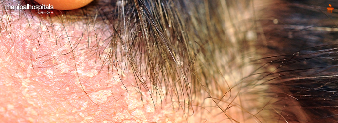 Dermatitis treatment