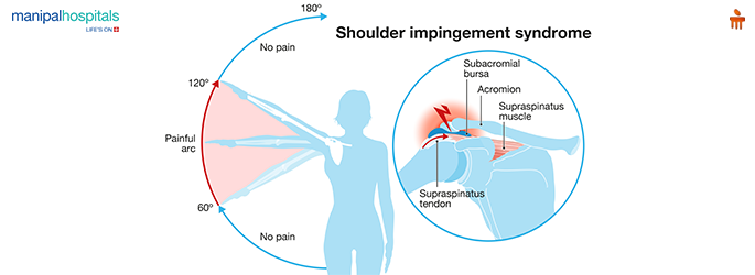 Shoulder impingement syndrome