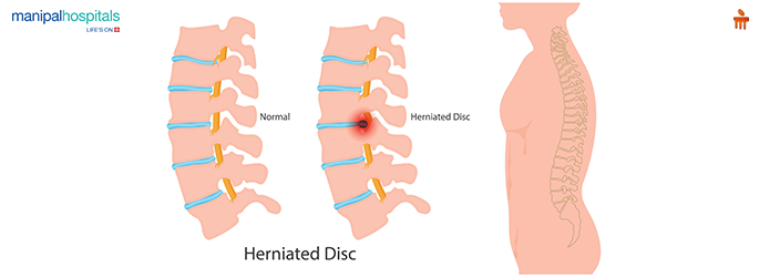 back pain causes