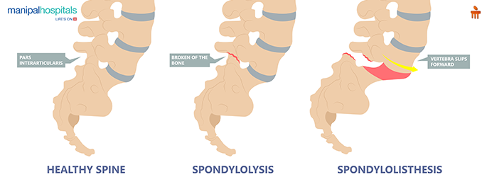 Spinal stenosis symptoms