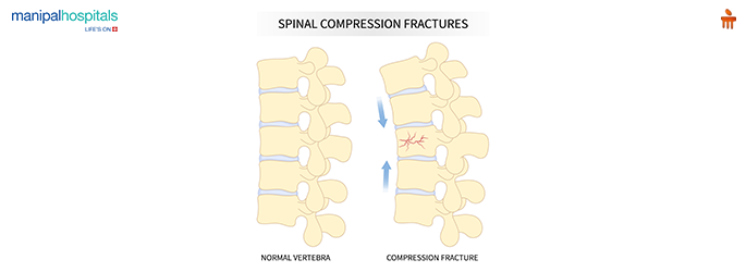 Spine Surgery