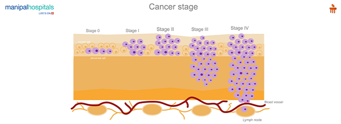 How Many Stages Of Cancer