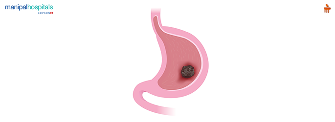 Stomach cancer lump