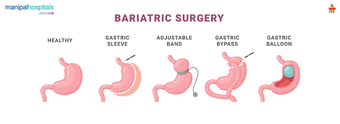 bariatric surgery risks