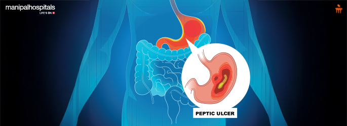 stomach ulcer symptoms