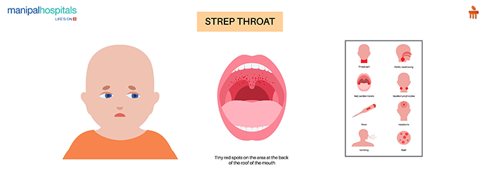 Strep throat symptoms and prevention tips