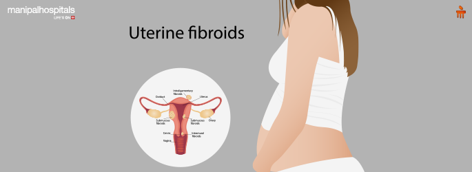 Subserosal Uterine Fibroid Treatment Options: From Laser Therapy to Natural Remedies