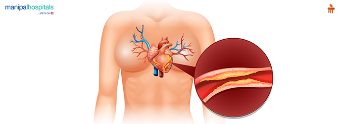 Banner showing early warning signs and symptoms of blocked arteries in the heart and neck