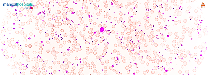 Thrombocytosis symptoms causes and treatment