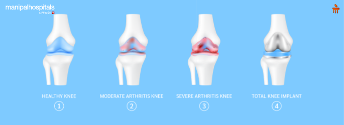 Types of Knee Replacement