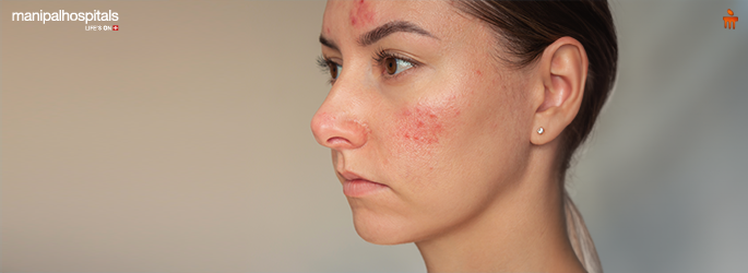 Eczema symptoms, types, and treatment options