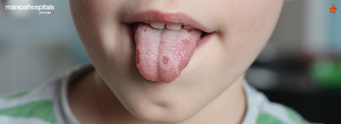 Understanding Geographic Tongue: What You Need to Know